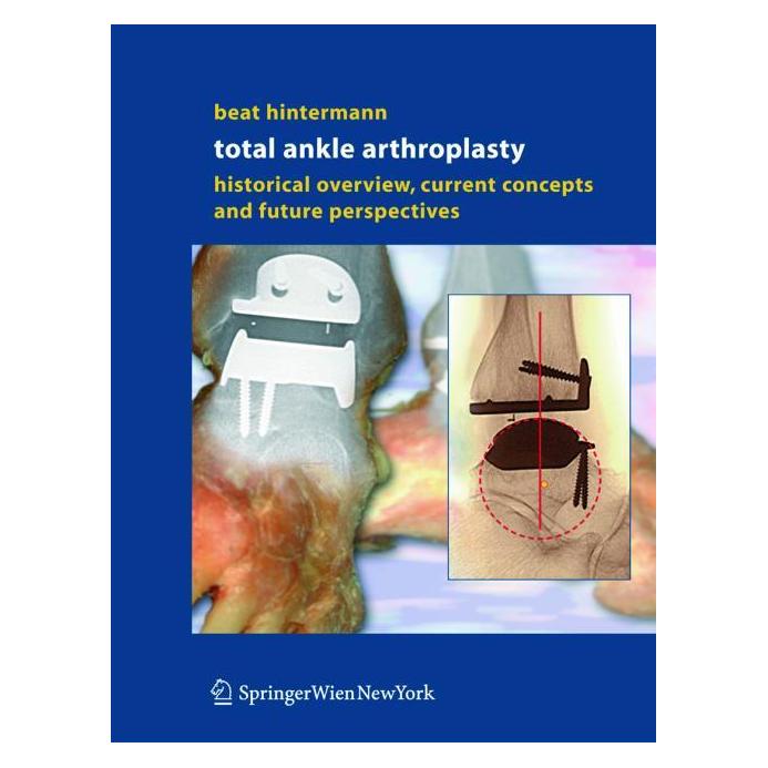 Springer Hintermann:Total Ankle Arthroplasty (Englisch, Hardcover, Beat Hintermann) (67795993)