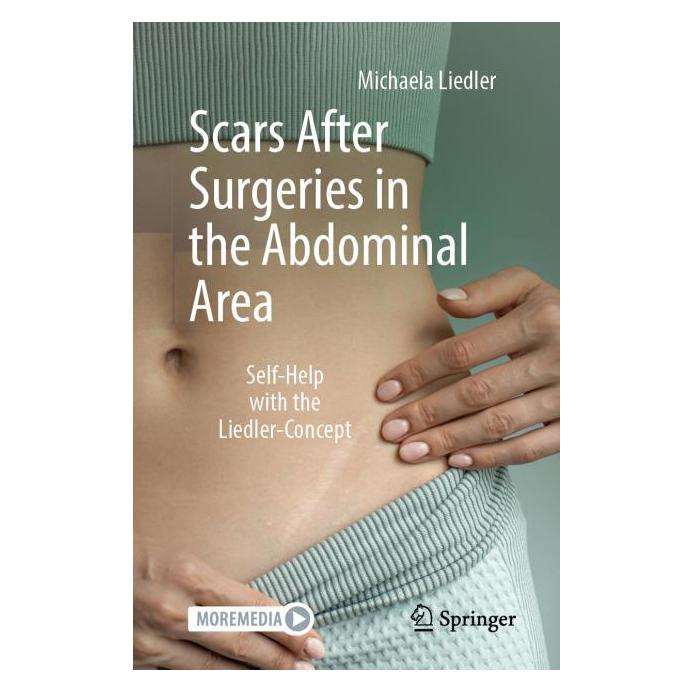 Springer Scars After Surgeries in the Abdominal Area (Englisch, Softcover, Michaela Liedler) (58161020)
