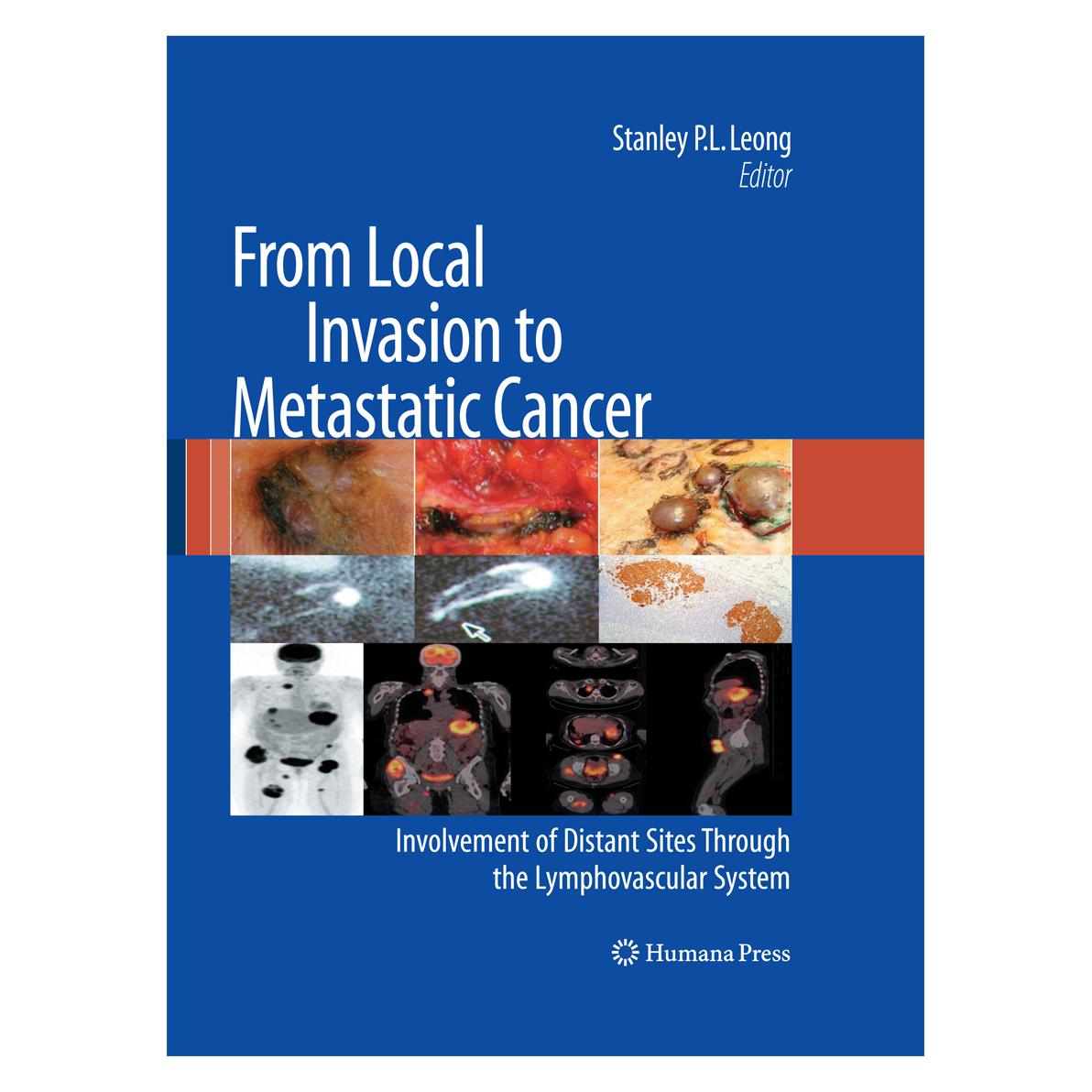 Springer From Local Invasion to Metastatic Cancer (Englisch, Softcover, Stanley P. L. Leong) (55581165)