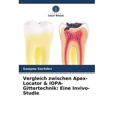 Vergleich zwischen Apex-Locator & IOPA-Gittertechnik: Eine Invivo-Studie, Taschenbuch von Swapna Sachdev, Verlag Unser Wissen, 978-620-3-80940-4