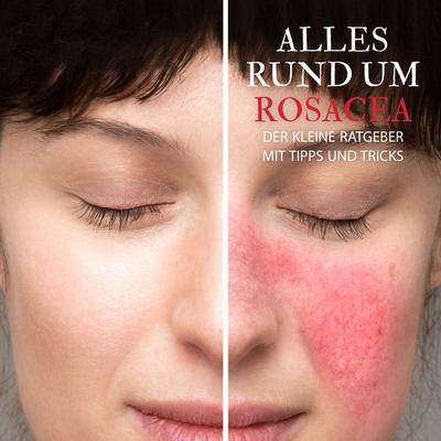 Alles Rund um Rosacea - Der kleine Ratgeber mit Tipps und Tricks - Raphael Kleine-Termeer, Audio, 4067248209714