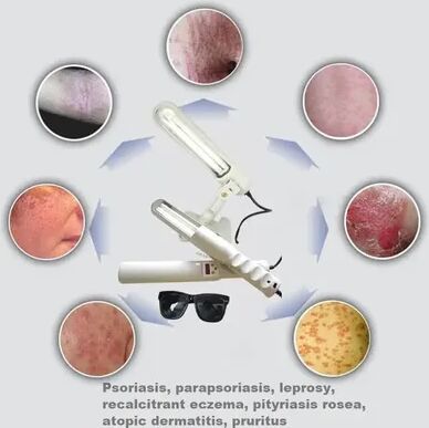 StayWell UV 311nm Ultraviolet Phototherapy Device Uses Philips Lamp UVB To Treat Vitiligo, Psoriasis, White Spots, Skin Diseases 110v Us Plug