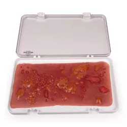 Wundmoulage einer Verbrennung des II. Grades