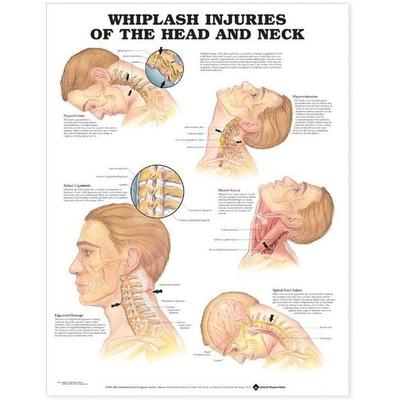Whiplash Injuries of the Head and Neck Anatomical Chart, Nonbook von Tbd, Wolters Kluwer Health, 978-1-58779-376-9
