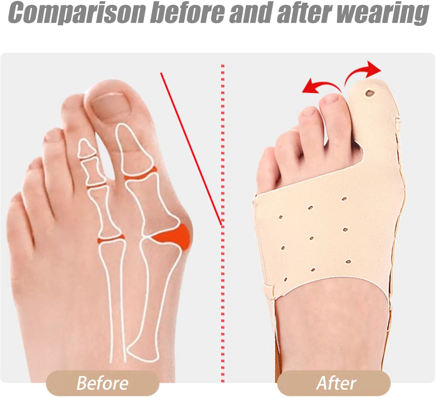 INF Ballenkorrektor für Hallux Valgus, Verstellbare Zehenrichtschiene S