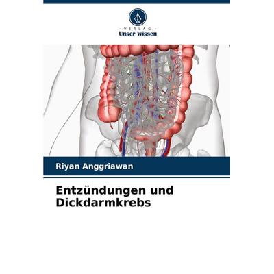 Entzündungen und Dickdarmkrebs, Taschenbuch von Riyan Anggriawan, Verlag Unser Wissen, 978-620-6-62038-9