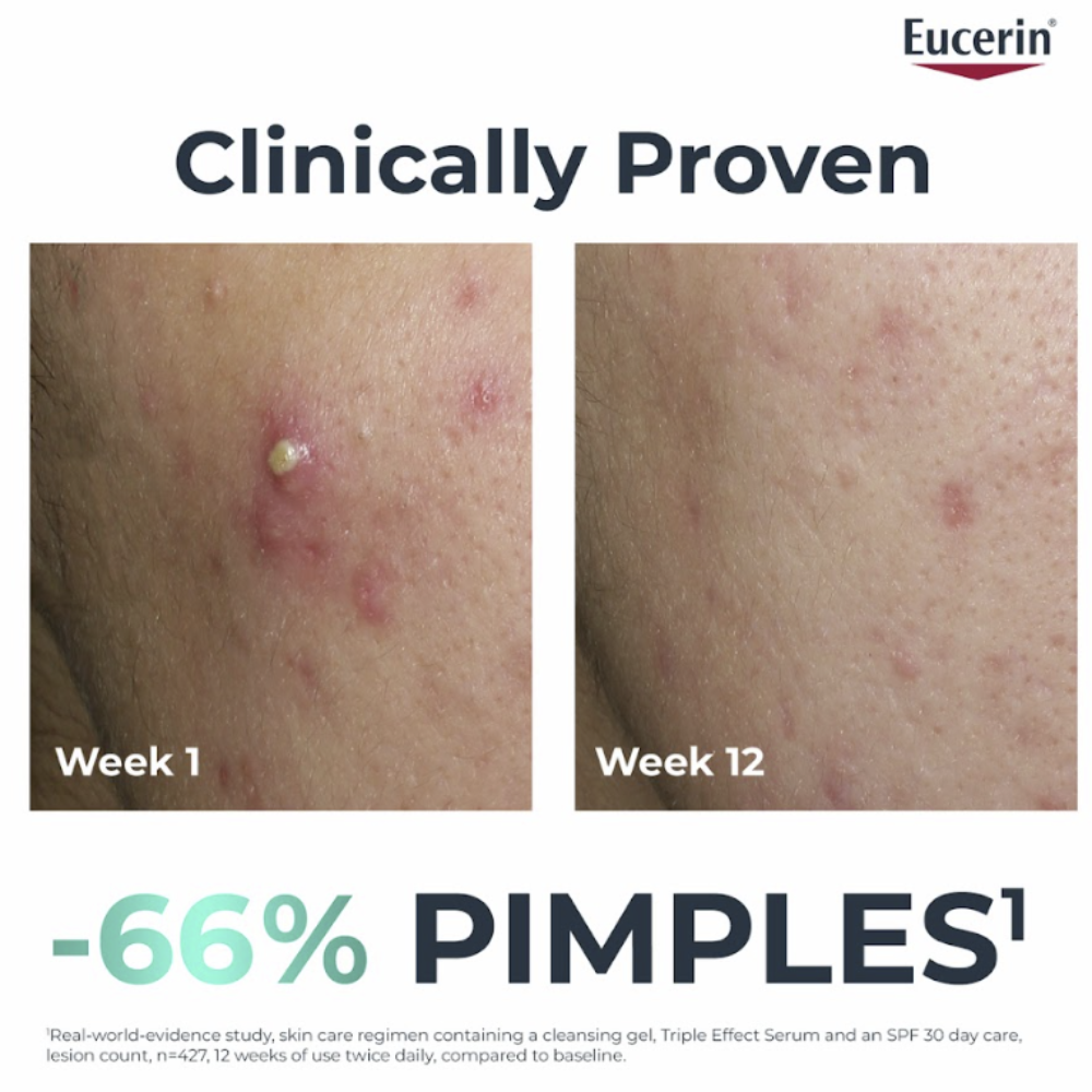 Eucerin DermoPure Clinical Triple Effect Serum Post-Acne Marks Reduction 40mL