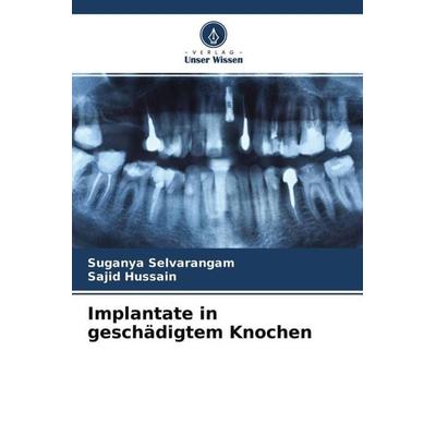 Implantate in geschädigtem Knochen, Taschenbuch von Suganya Selvarangam,Sajid Hussain, Verlag Unser Wissen, 978-620-4-68422-2
