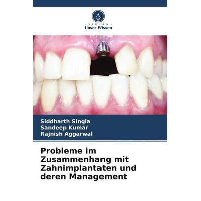 Probleme im Zusammenhang mit Zahnimplantaten und deren Management, Taschenbuch von Siddharth Singla,Sandeep Kumar,Rajnish Aggarwal, Verlag Unser