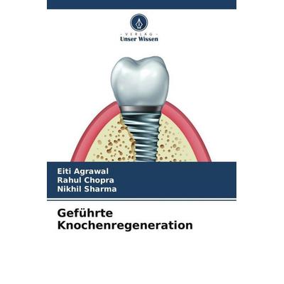 Geführte Knochenregeneration, Taschenbuch von Eiti Agrawal,Rahul Chopra,Nikhil Sharma, Verlag Unser Wissen, 978-620-4-82084-2