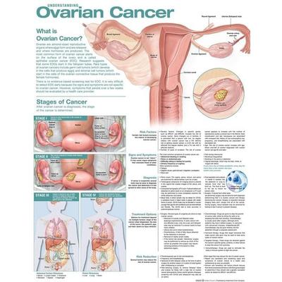 Understanding Ovarian Cancer Anatomical Chart, Nonbook von , Ingram Publishers Services, 978-1-975192-32-7