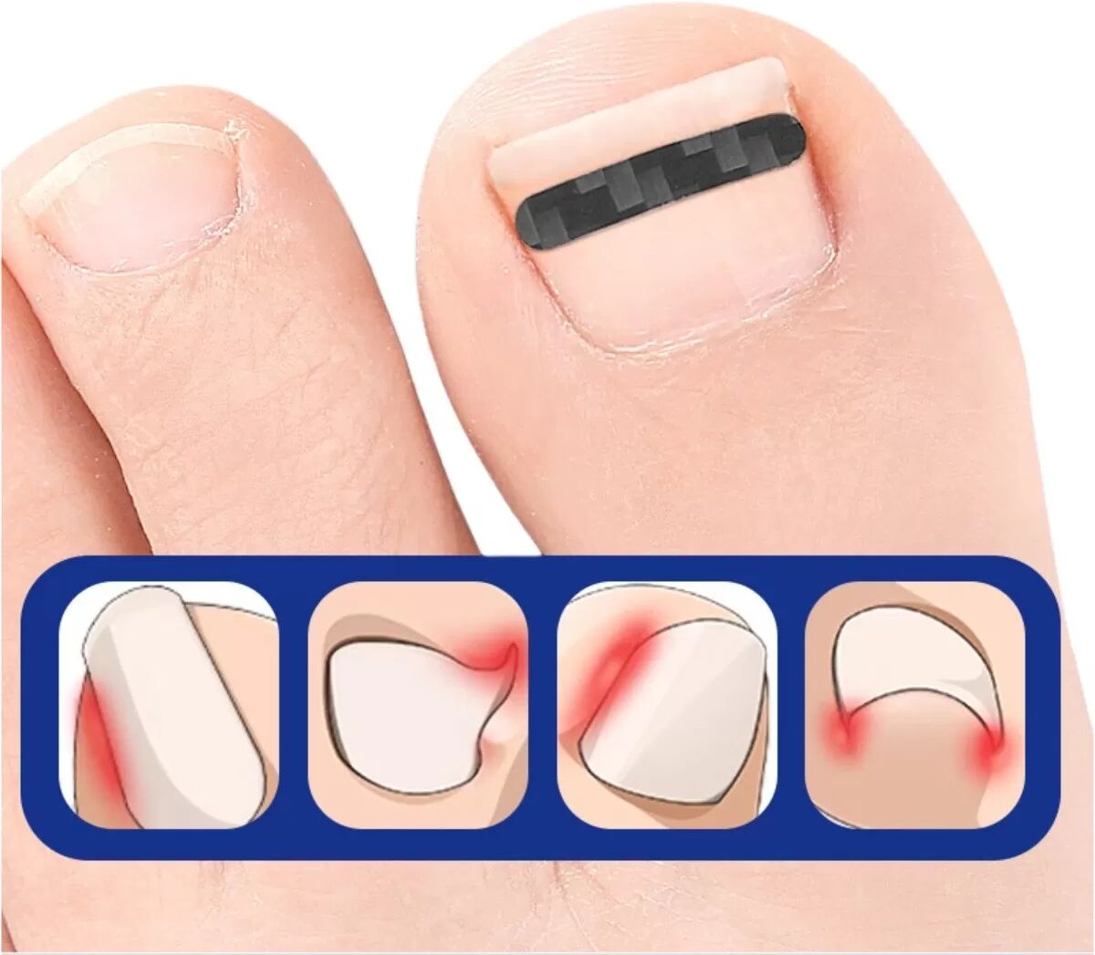 INF Patchs Correcteurs d'Ongles Incarnés en Fibre de Carbone - 4x22mm - 10 Pièces - Force 3N