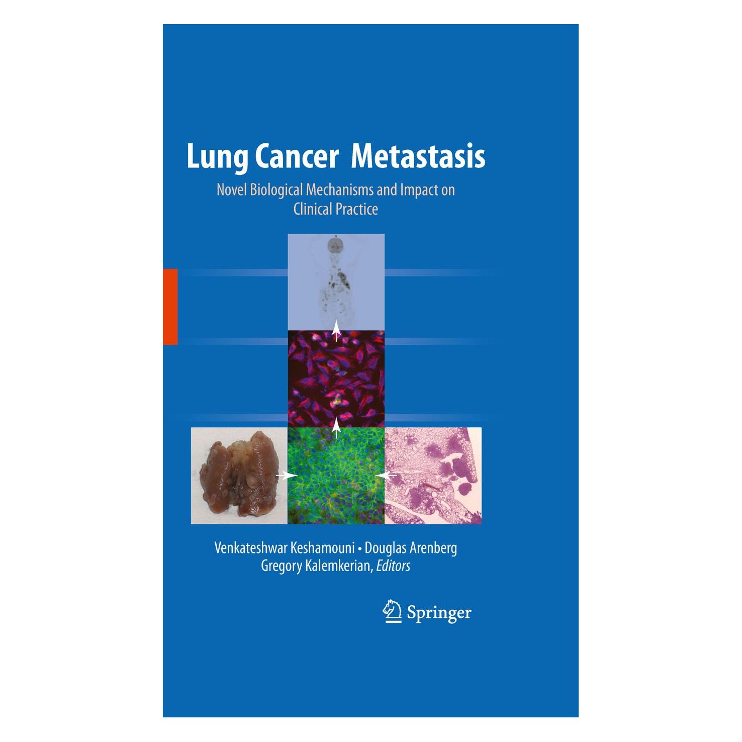 Springer Lung Cancer Metastasis (Englisch, Hardcover, Douglas Arenberg, Gregory Kalemkerian, Venkateshwar Keshamouni) (9781441907714)