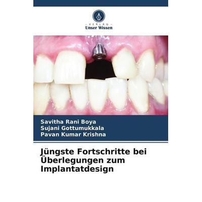 Jüngste Fortschritte bei Überlegungen zum Implantatdesign, Taschenbuch von Savitha Rani Boya,Sujani Gottumukkala,Pavan Kumar Krishna, Verlag Unser