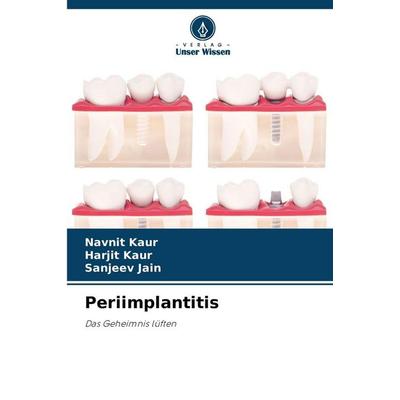 Periimplantitis, Taschenbuch von Navnit Kaur,Harjit Kaur,Sanjeev Jain, Verlag Unser Wissen, 978-620-9-32521-2