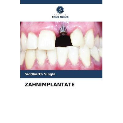 ZAHNIMPLANTATE, Taschenbuch von Siddharth Singla, Verlag Unser Wissen, 978-620-4-79384-9
