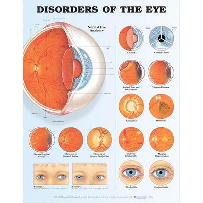 Disorders of the Eye Anatomical Chart