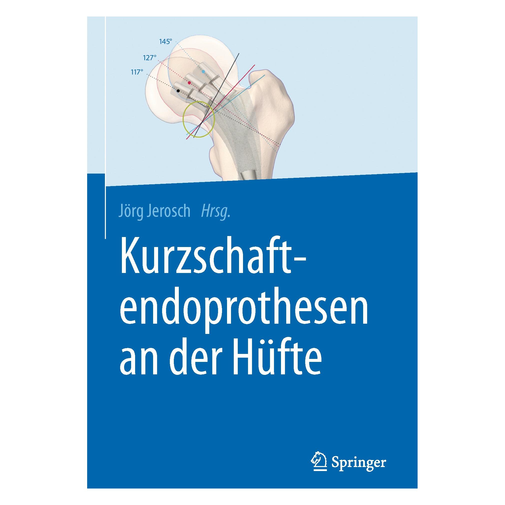 Springer Kurzschaftendoprothesen an der Hüfte (Deutsch, Hardcover, Jörg Jerosch) (9783662527436)