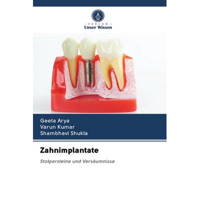 Zahnimplantate, Taschenbuch von Geeta Arya,Varun Kumar,Shambhavi Shukla, Sciencia Scripts, 978-620-2-85531-0