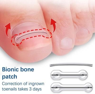 Uplifted Goods Foot Care Ingrown Toenail Correction Kit 0.75in 2pcs