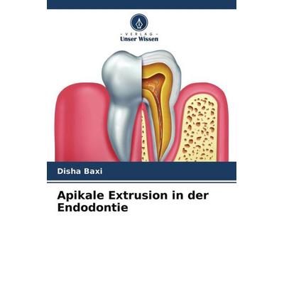 Apikale Extrusion in der Endodontie, Taschenbuch von Disha Baxi, Verlag Unser Wissen, 978-620-4-67775-0