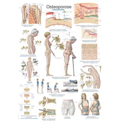 Lehrtafel Osteoporose  50x70cm