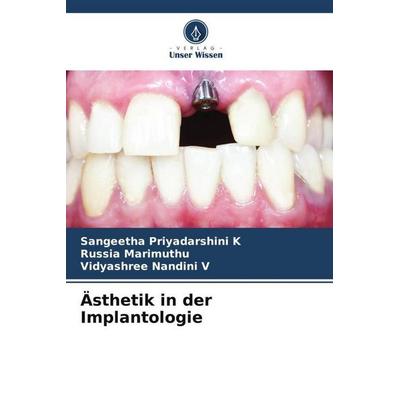 Ästhetik in der Implantologie, Taschenbuch von Sangeetha Priyadarshini K.,Russia Marimuthu,Vidyashree Nandini V., Verlag Unser Wissen,