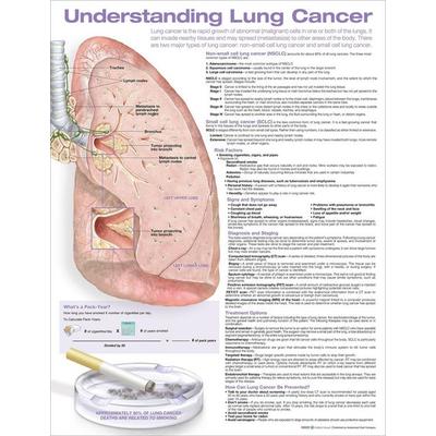 Understanding Lung Cancer Anatomical Chart, von , Ingram Publishers Services, 978-1-975192-36-5