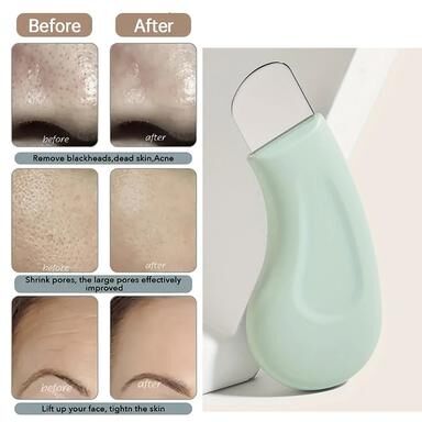 Combo Retail Shop Black Head And White Head Removal Tool For Nose And Face, Pore Cleaner Skin Care Tools For Women Black Head And White Head Removal Tool For Nose And Face, Pore Cleaner Skin Care Tools For Women