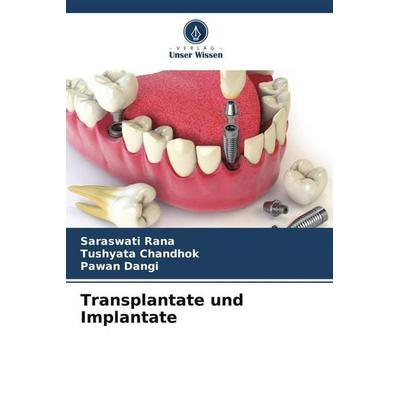 Transplantate und Implantate, Taschenbuch von Saraswati Rana,Tushyata Chandhok,Pawan Dangi, Verlag Unser Wissen, 978-620-6-57506-1