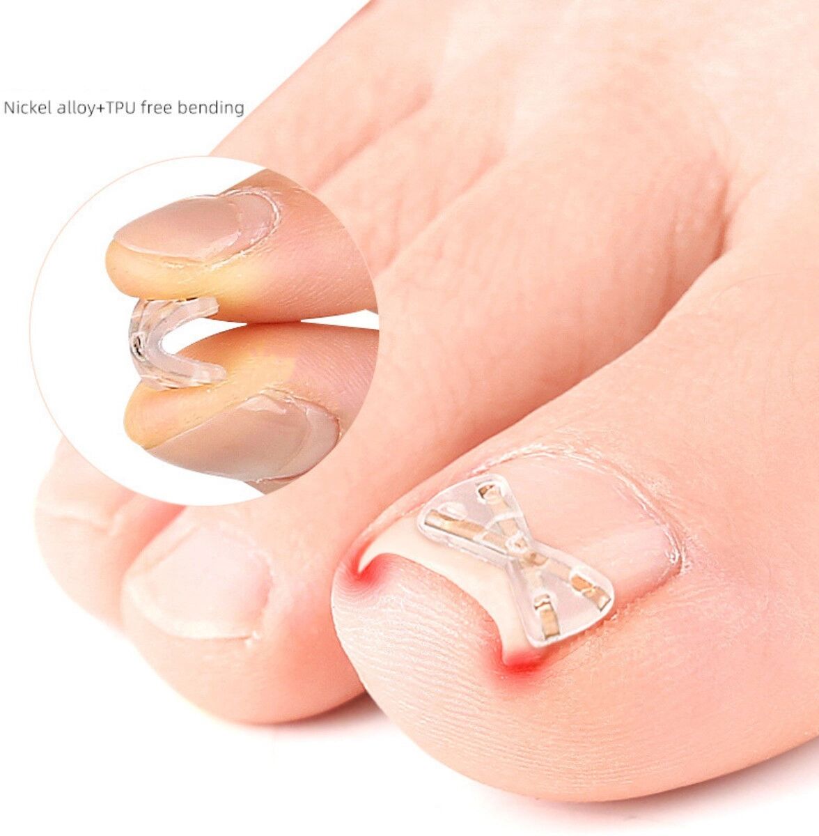 INF Patch papillon pour ongle incarné en X 2 pcs - Alliage de titane, correction invisible de l'orteil Or rose