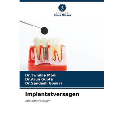 Implantatversagen, Taschenbuch von Twinkle Modi,Arun Gupta,Sandesh Gosavi, Verlag Unser Wissen, 978-620-7-43058-1