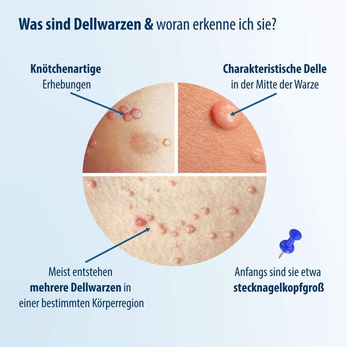 Evolsin medical UG (haftungsbeschränkt) EVOLSIN Dellwarzen Mittel Lösung 5 ml