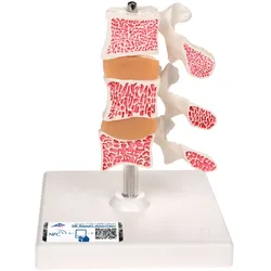 Osteoporose Modell mit 3 Lendenwirbeln, auf Stativ - 3B Smart Anatomy