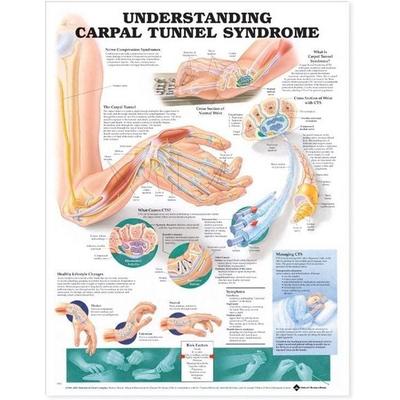 Understanding Carpal Tunnel Syndrome Anatomical Chart, Nonbook von Tbd, Wolters Kluwer Health, 978-1-58779-322-6