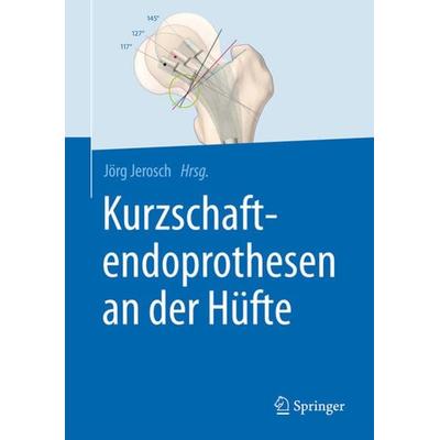 Kurzschaftendoprothesen an der Hüfte, Gebundene Ausgabe von , Springer Berlin, 978-3-662-52743-6