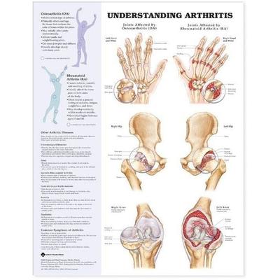 Understanding Arthritis Anatomical Chart, von , Wolters Kluwer Health, 978-1-58779-385-1