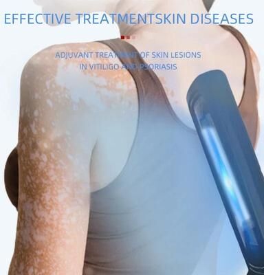 Uplifted Finds UVB 311nm Narrowband Phototherapy Lamp For Psoriasis & Vitiligo UVB 311nm Narrowband Phototherapy Lamp For Psoriasis & Vitiligo