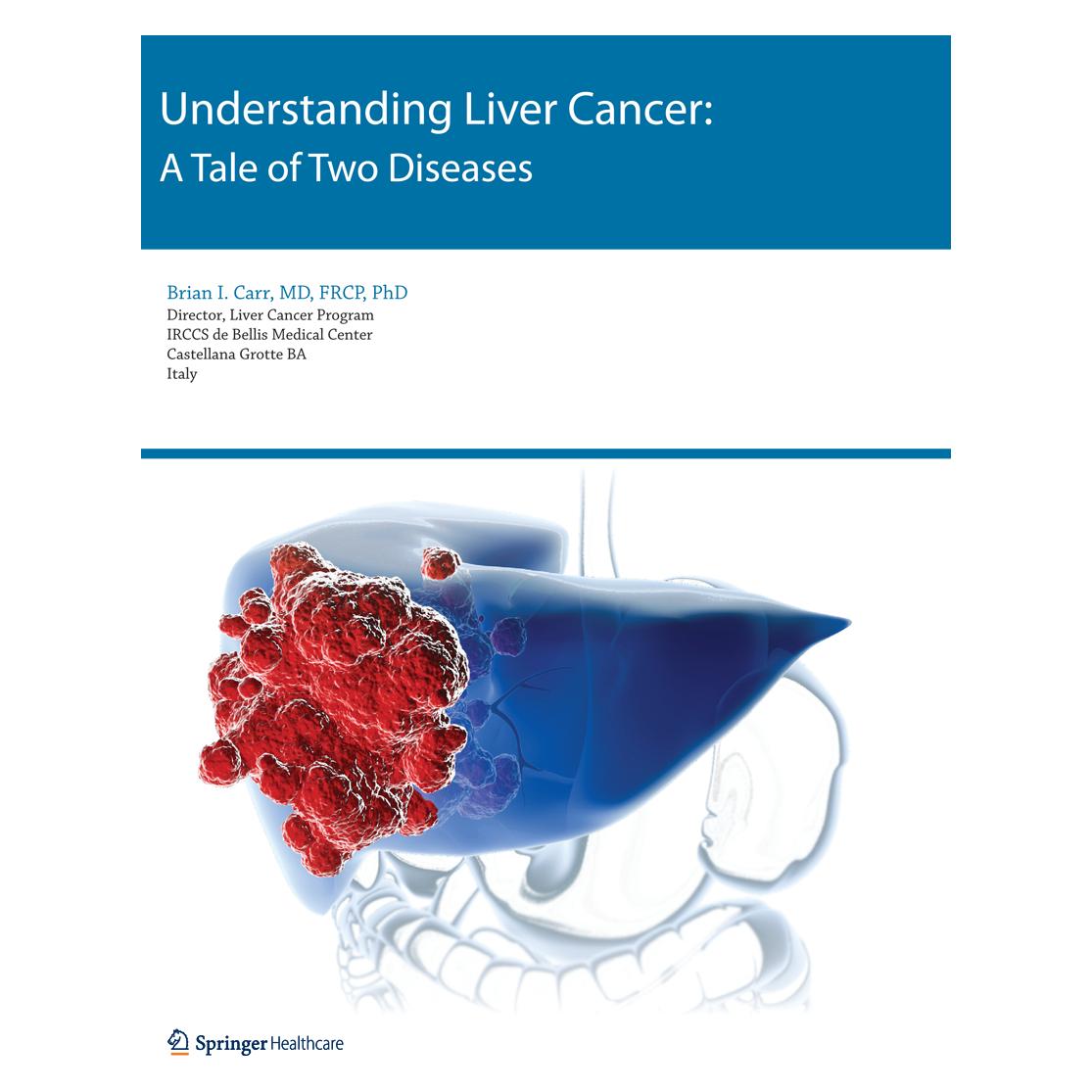 Springer Understanding Liver Cancer (Englisch, Softcover, Brian I. Carr) (55556619)