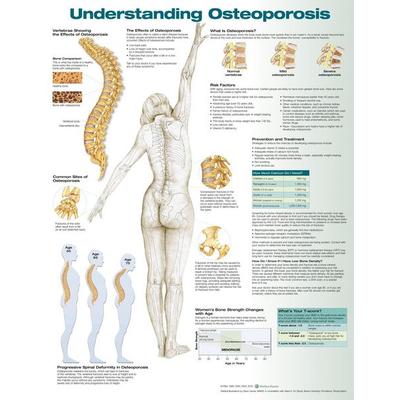 Understanding Osteoporosis Anatomical Chart, von , Ingram Publishers Services, 978-1-4963-6249-0