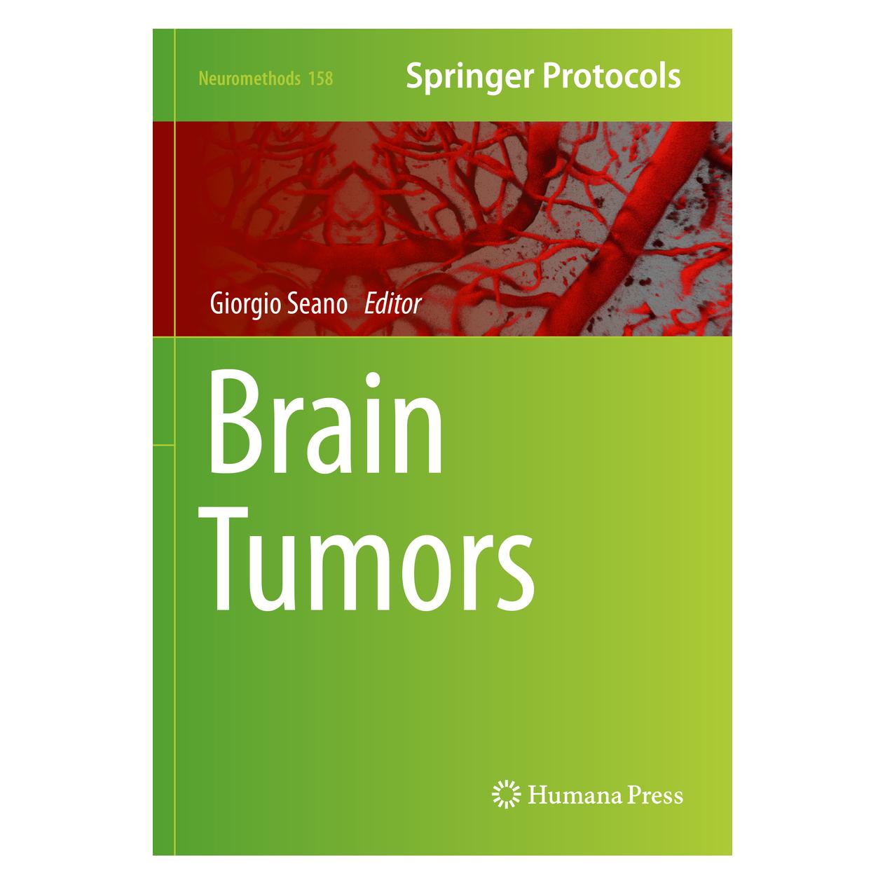 Springer Brain Tumors (Englisch, Softcover) (35070617)