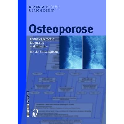 Osteoporose, Gebundene Ausgabe von Klaus M. Peters,Ulrich Deuss, Steinkopff, 978-3-7985-1465-2