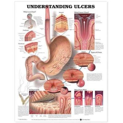 Understanding Ulcers Anatomical Chart, Nonbook von , Wolters Kluwer Health, 978-1-58779-370-7