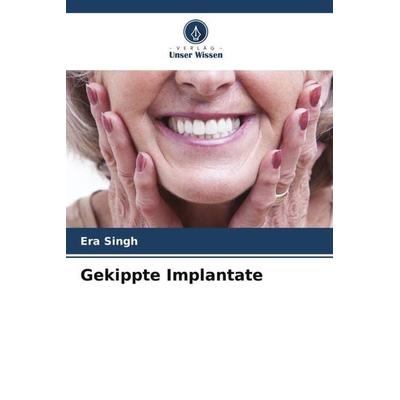 Gekippte Implantate, Taschenbuch von Era Singh, Verlag Unser Wissen, 978-620-5-43859-6