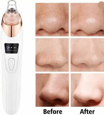 Inspire Essentials ClearGlow Facial Pore Cleaner Blackhead Remover Vacuum Kit white