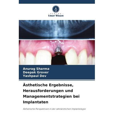 Ästhetische Ergebnisse, Herausforderungen und Managementstrategien bei Implantaten, Taschenbuch von Anurag Sharma,Deepak Grover,Yashpaul Dev, BoD -