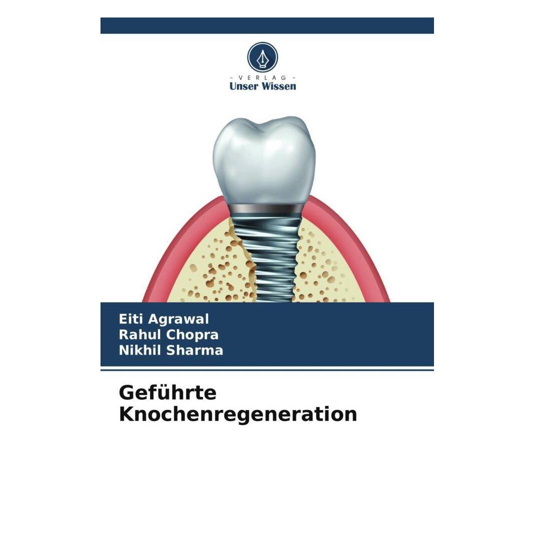 Unser Wissen Geführte Knochenregeneration (56857070)