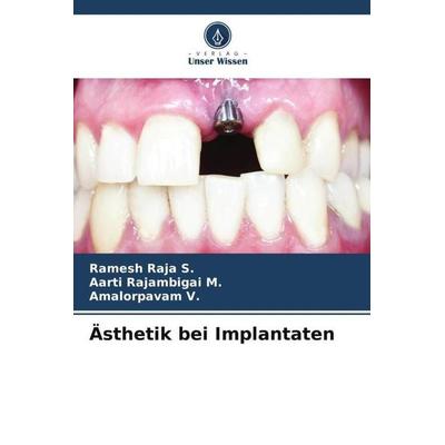 Ästhetik bei Implantaten, Taschenbuch von Ramesh Raja S.,Aarti Rajambigai M.,Amalorpavam V., Verlag Unser Wissen, 978-620-5-07387-2