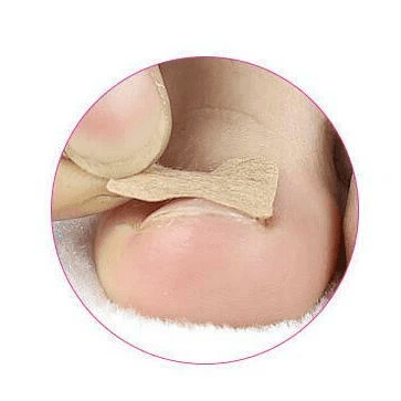 All Categories Goods Toenail Corrector Sticker, Ingrown Toe Foot Nail Fix, Pedicure Tool For Quick Relief And Healing Toenail Corrector Sticker, Ingrown Toe Foot Nail Fix, Pedicure Tool For Quick Relief And Healing