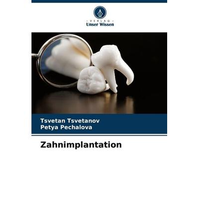 Zahnimplantation, Taschenbuch von Tsvetan Tsvetanov,Petya Pechalova, Verlag Unser Wissen, 978-620-8-51005-3
